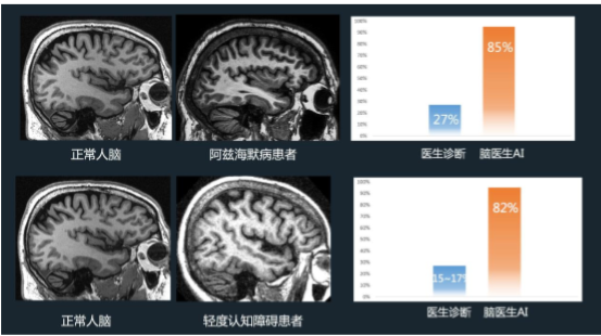 铱硙脑医生在老年痴呆症和认知障碍等病例诊断准确率远高于人类医生。